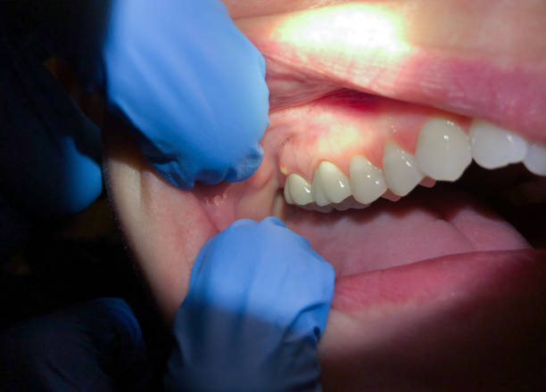 Best Emergency Dentist for Lost Fillings or Crowns in Petersburg, AK